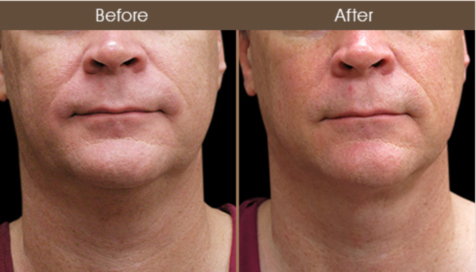 Laser Neck Lift Before And After In NYC
